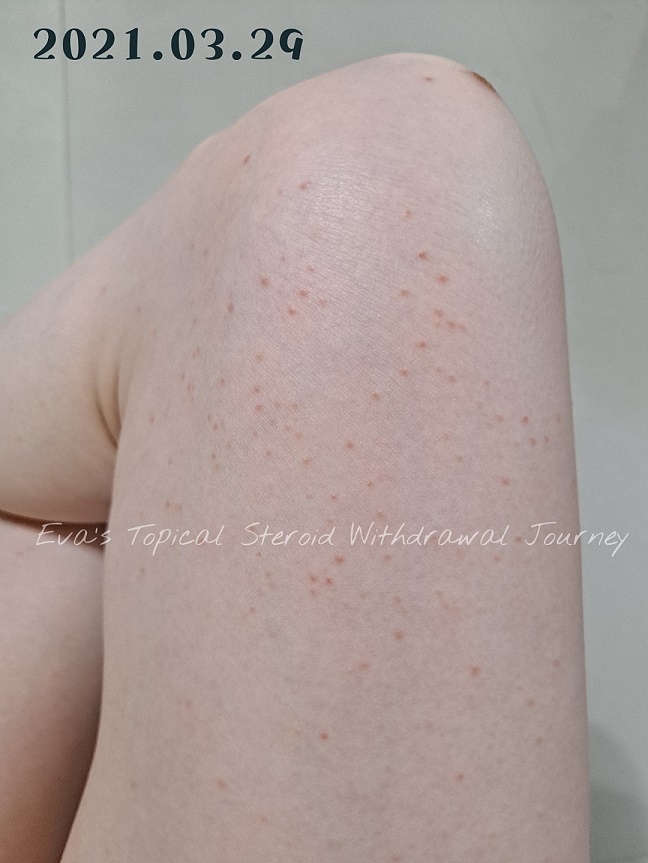 Vitaway森林SPA活水沐浴過濾器_開箱體驗_kol開箱_紅皮膚_皮膚炎